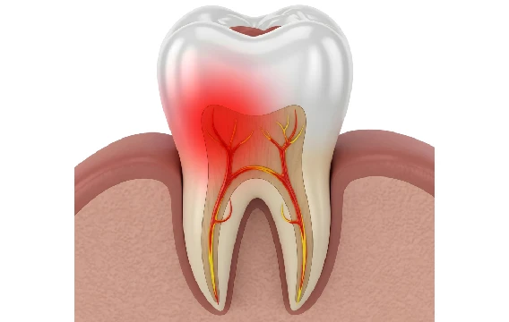 Root Canal Treatment in Chembur